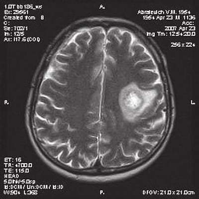 Концентрический склероз Бало на МРТ